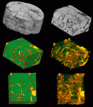 Sequence of images of a 1" (25 mm) core of fractured limestone. Micro-CT data provides a full geometric description of pore space in the rock. This new data provides previously unattainable rigor to be brought to such problems as the relationship between porosity and permeability, the form of flow paths through the rock, including pore throat sizes, and the effects that artificially induced fractures will have on true permeability for secondary and tertiary recovery in mature oil fields. (top left) A complete three-dimensional reconstruction of the scanned volume. (top right) A cubic subsection cut from the main volume. (middle, bottom left) A pseudocolor rendering of the subsection, showing limestone as green and pore space as yellow. (middle, bottom right) The limestone has been made partially transparent, allowing the three-dimensional shapes of the fractures to be seen, as well as some details about how they interact. (Sample provided by Dr. Brenda Kirkland-George, University of Texas at Austin)
