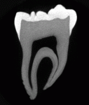 100 micron slice through a human molar, 12 mm in length. Using high-resolution X-ray CT to image the tooth permits the non-destructive measurement of enamel thickness and volume for studies of dental development. (Sample provided by Dr. David Gantt, Georgia Southern University).
